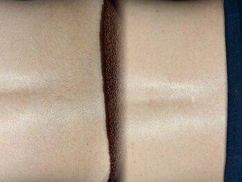 グラスト(Grast)/背中脱毛・福岡/大橋/天神/博多