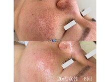 オウジエステサロン(OJIエステサロン)/20代女性　プロセル8回