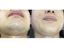 ナノハナ/鹿沼市全身脱毛美容室ナノハナ