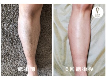 ヴォアール 名古屋店(VOIR)/メンズ脱毛　ひざ下脱毛