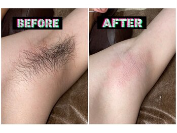 メンズスリーナインサロン(Men's ThreeNines Salon)/脇脱毛