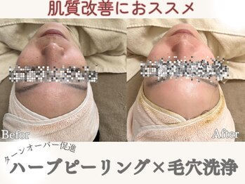 マヴィ 高槻店(MavY.)/根強い人気☆ハーブピーリング