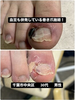 巻き爪じゅん 船橋店/巻き爪と血豆が併発し施術!