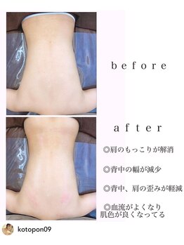 ブレス 夙川店(Bless)/Before After(背中)