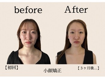 ラフルール 表参道(La fleur)の写真/普通の小顔矯正は終わり！ヘッドスパで頭から引き上げる小顔矯正が効果的☆