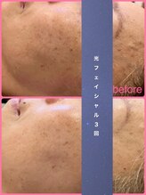 ミレボ(Me.rebo)/光フェイシャルbefore→after