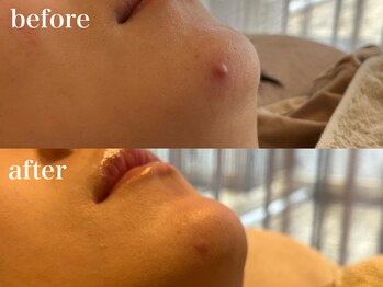 ハリノヒ 大阪院/ニキビケア美容鍼