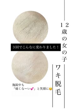 リードエピア(LEADepiA)/10才から出来るキッズ脱毛