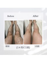 ティグレ 岡山店(TIGRE)/メンズ全身脱毛（顔VIO込）