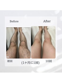 ティグレ 岡山店(TIGRE)/メンズ全身脱毛(顔VIO込)