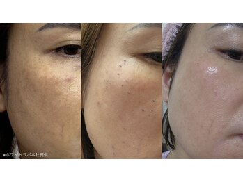 ブレデサガ(B’lady Saga)/次世代シミケア【ホワイトラボ】