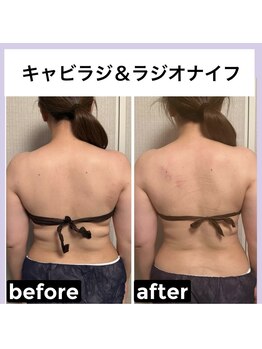 アンベリール(embellir)/徹底痩身キャビ＆ラジオナイフ