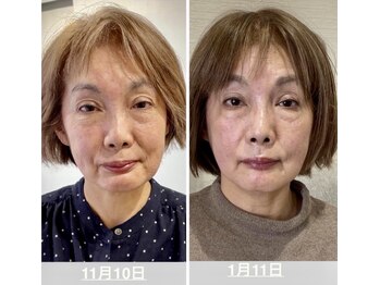 鍼日和/初回限定3回券　鬼美容鍼