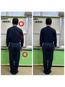 名駅整体院/側弯・歪み（施術前・施術後）