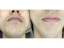 ナノハナ/鹿沼市全身脱毛美容室ナノハナ