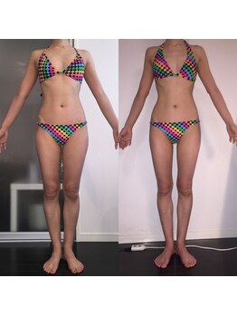 レナトゥス 銀座(Renatus)/BeforeAfter【痩身/東京/銀座】