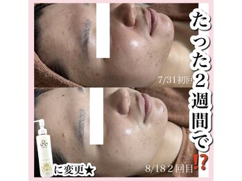 ホワイトアクア 天王寺本店(WHITE AQUA)/ハーブピーリング/大阪/天王寺