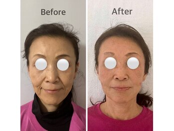 エソア(esoa)/60代 小顔矯正