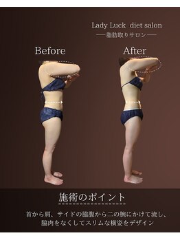 レディラック 大阪梅田本店(Lady Luck)/マイクロウェーブリフトコース