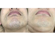 ナノハナ/鹿沼市全身脱毛美容室ナノハナ