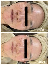 ジャスミン(Jasmin)/臍帯血幹細胞×NMN×AC-11