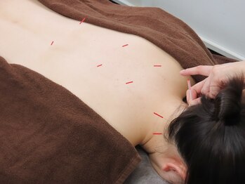 とまり木鍼灸整骨院 北青山院/辛い肩こりや腰痛に