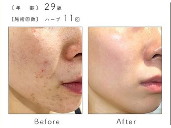 カノン(Kanon.)/リベルハーブピーリング