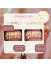 プラスビー 2号店(+b)/ホワイトニングビフォーアフター