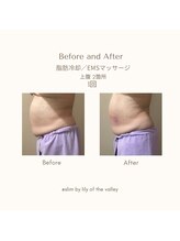 スリム(SLIM by lily of the valley)/脂肪冷却早くやればよかった