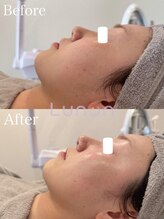 ルノン(Lunon)/毛穴洗浄ハイドロ×ララピール