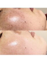 イリマレイサロン(iLima Lei SALON)/シミを作らせない