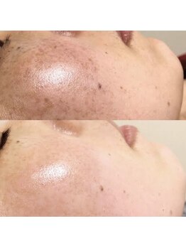イリマレイサロン(iLima Lei SALON)/シミを作らせない