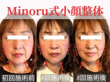 フレキシボディ(FlexiBody)/小顔施術ビフォーアフター #16