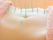 鍼灸治療院ヒカリ(hikari)/【鍼灸】３．施術