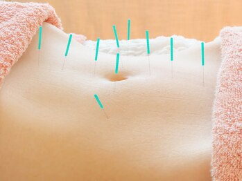 鍼灸治療院ヒカリ(hikari)/【鍼灸】３．施術