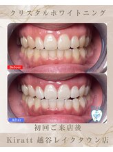 キラット 越谷レイクタウン店(Kiratt)/ビフォーアフター　8