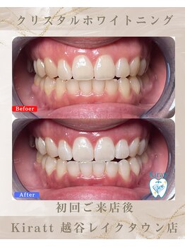 キラット 越谷レイクタウン店(Kiratt)/ビフォーアフター　8