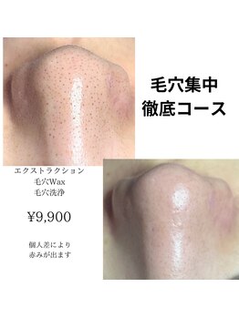 オウカ(OUKA)/黒ずみに毛穴エクストラクション