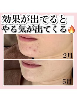 アルムダアクア 天王寺店(Aleumda AQUA)/ハーブピーリング/大阪/天王寺