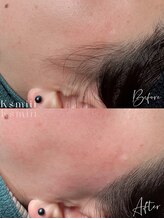 キスミー(Ksmiii)/フェイスワックス脱毛(もみあげ)