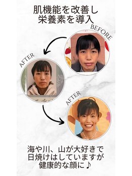 ひなた(salon)/フェイシャル施術4ヶ月後