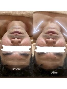 インナーメス(INNER MES)/フェイスラインが現れる!?