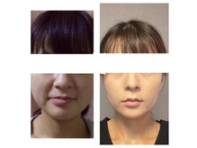 サロン ド ルポゼ(Salon de Reposer)の雰囲気(1番人気★サーマショット付き小顔矯正)