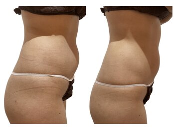 痩せラボ/うきわ肉改善【痩身】