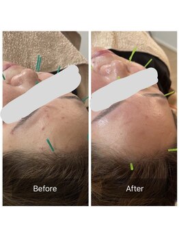 鍼灸院 はりのひと/美容鍼4回のビフォーアフター