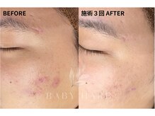 フィズ 新宿店(FIS)の雰囲気（ハーブピーリングメニューも◎[新宿/新宿三丁目/毛穴/美肌]）