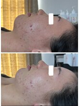 ビジュープラス 幸手店(Bijou+)/毛穴・ニキビケア