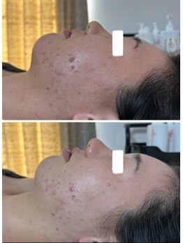 ビジュープラス 幸手店(Bijou+)/毛穴・ニキビケア