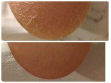 フットケアサロン ラビフット(Rabbi foot)/ひび割れ踵、亀裂が深くなる前に