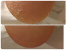 ひび割れ踵、亀裂が深くなる前に